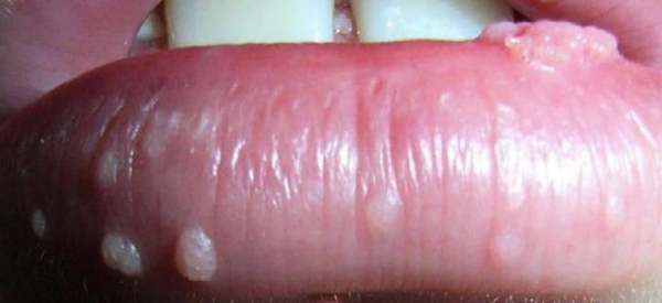 Папиллома на губе: что делать и как лечить?