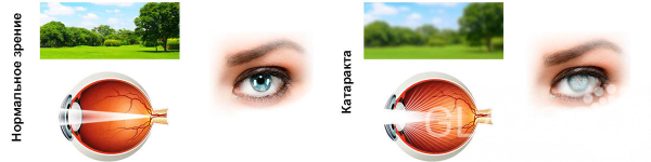 Катаракта глаза: причины, симптомы, диагностика, лечение