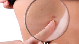 Папиллома увеличилась: диагностика и лечение