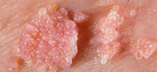 Бородавки на мошонке: причины и лечение