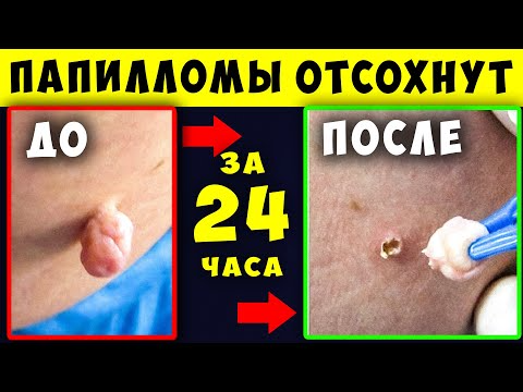 Как избавиться от висячих папиллом?