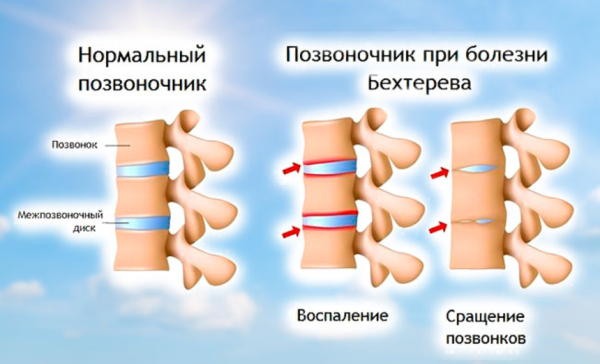 Спондилит: причины, симптомы и лечение воспаления позвоночника