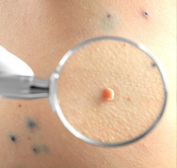 Папилломы на теле: причины появления и способы лечения