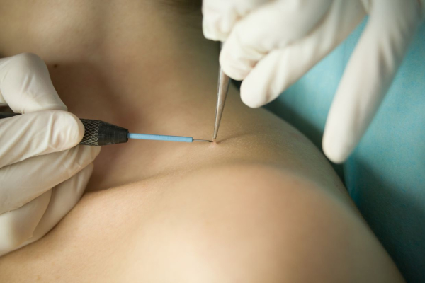 Что делать, если лопнула папиллома?