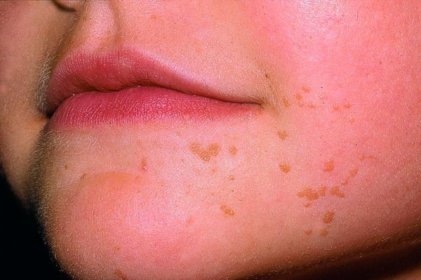 Плоские бородавки у детей: причины, симптомы и лечение