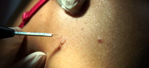 Удаление папиллом радиоволновым методом или лазером &mdash; что лучше