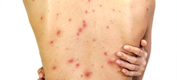 Сепсис: причины, симптомы, лечение и профилактика