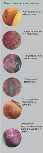 Как избавиться от папиллом на головке члена?