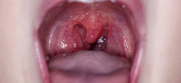 Папиллома на язычке в горле: симптомы и лечение
