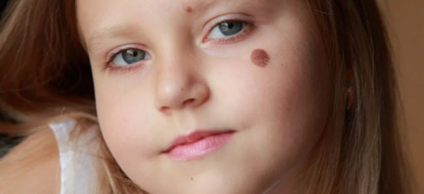 Бородавки на лбу у детей: причины появления и лечение