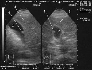Основные отличия полипов от папиллом