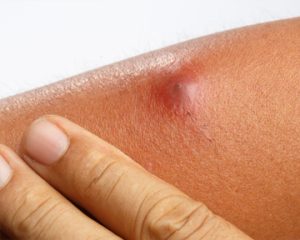 Отличия фолликулита и фурункула