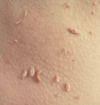 Основные отличия полипов от папиллом