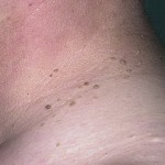 Можно ли удалять папилломы во время месячных?