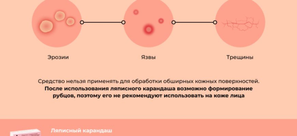Ляписный карандаш от папиллом и бородавок: инструкция по применению, отзывы