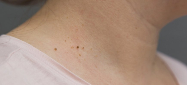 Как избавиться от папиллом на шее с помощью народных средств?