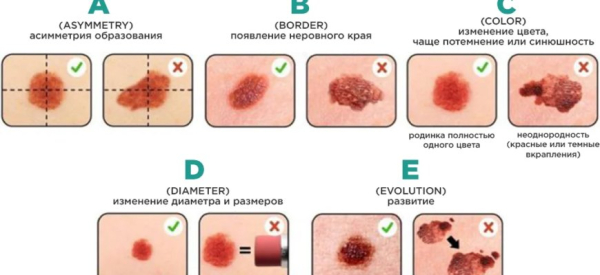 Виды папиллом: их цвета, на каких местах появляются