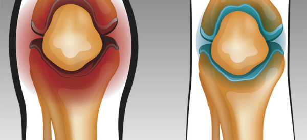 Синовит сустава: причины, симптомы, лечение, профилактика
