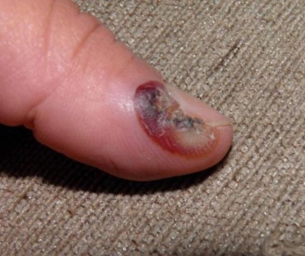 Поднялась температура после прижигания бородавки, что делать?