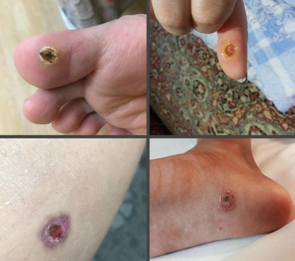 Уход за раной после удаления папилломы радиоволновым методом