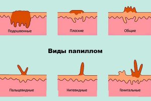 Почему появляются папилломы на шее у женщин и как их лечить?
