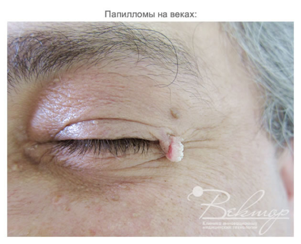 Как избавиться от бородавки на верхнем веке?