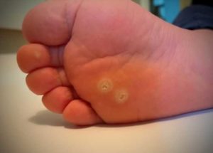 Как эфирное масло поможет удалить бородавки