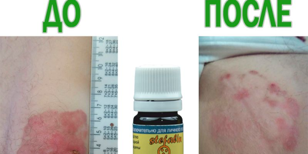 Мазь Стефалин от папиллом: цена, инструкция, отзывы