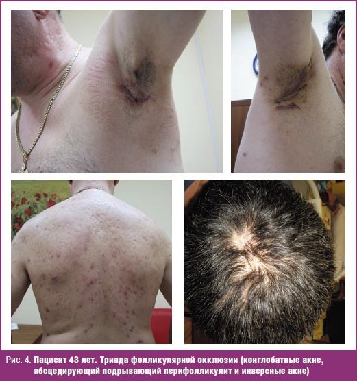 Отличия фолликулита и фурункула