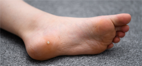 Бородавки на ногах: причины, симптомы, диагностика и лечение