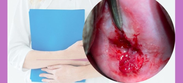 Папиллома матки при беременности