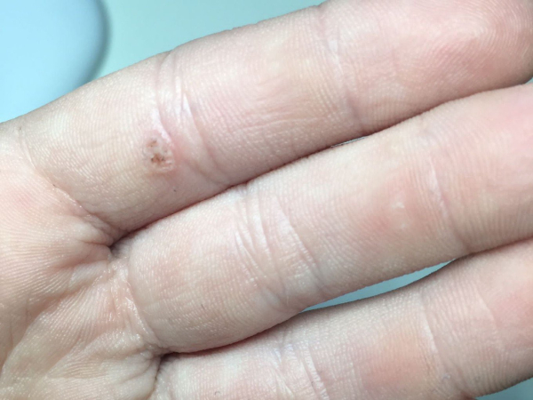 Подошвенные бородавки на пальце руки: причины и лечение