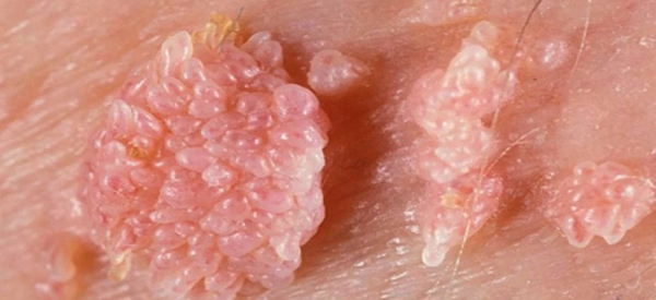 Остроконечные папилломы: причины, симптомы и лечение