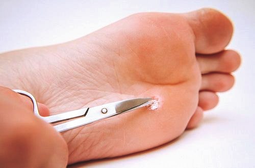 Как избавиться от бородавок на пятке