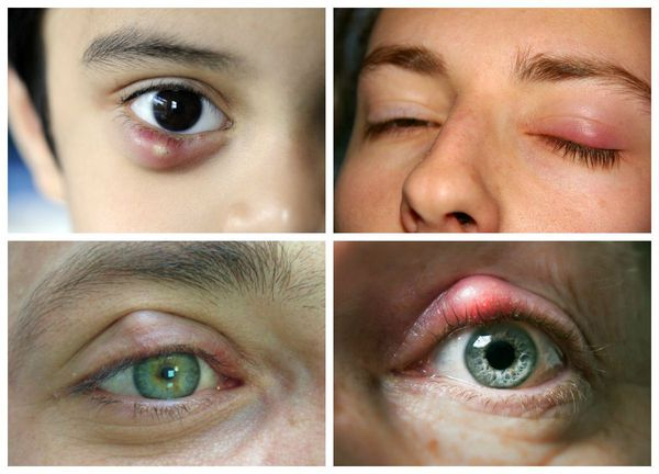 Халязион века: причины, симптомы и способы лечения