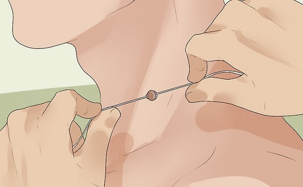 Можно ли перевязать папиллому ниткой: плюсы и минусы метода