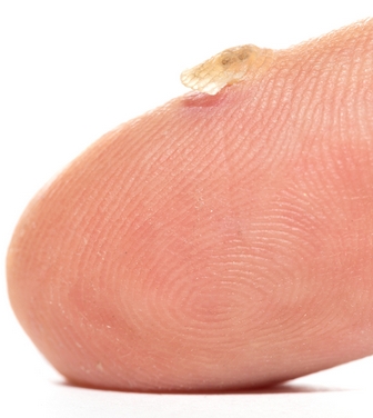 Последствия удаления бородавки на руке