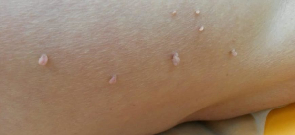 Можно ли перевязать папиллому ниткой: плюсы и минусы метода