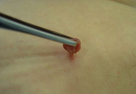 Болит папиллома, что делать?