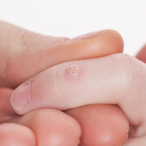 Папилломы на теле у ребенка: симптомы и лечение