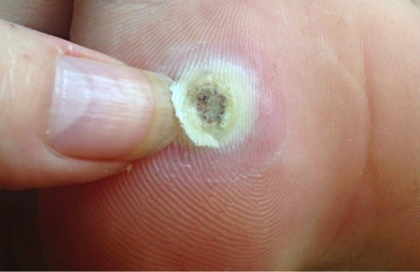 Лечение подошвенной бородавки лаком для ногтей