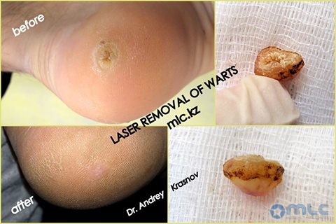 Подкожные бородавки на стопе: причины и лечение