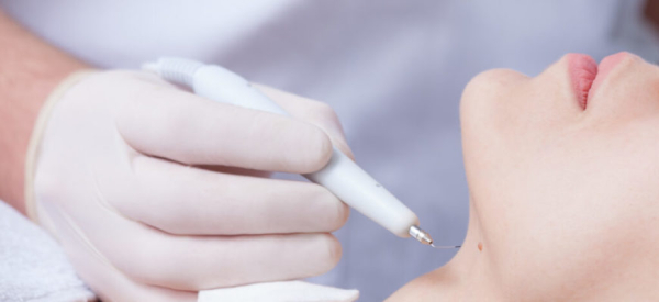 Можно ли удалять папилломы во время месячных?