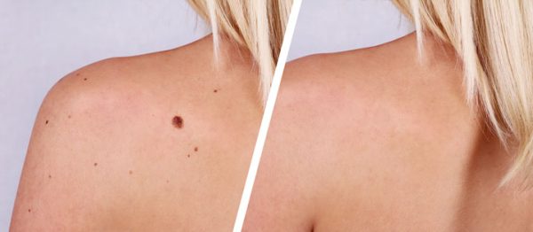 Можно ли в баню после удаления папиллом?