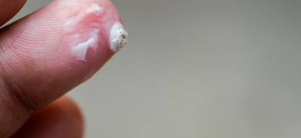 Причины, симптомы и лечение бородавок на ладони