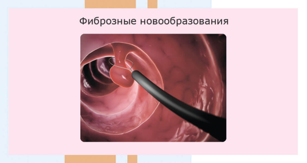 Папилломы в уретре у женщин: симптомы и лечение