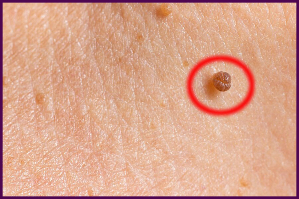 Отличия бородавки, папилломы и родинки