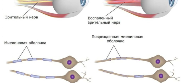 Неврит зрительного нерва: причины, симптомы, лечение