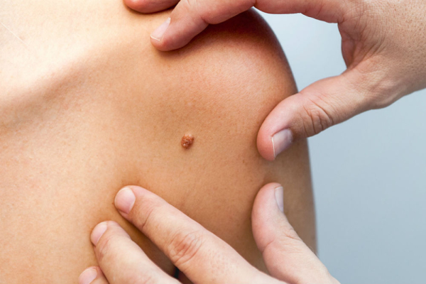 Остроконечные папилломы: причины, симптомы и лечение