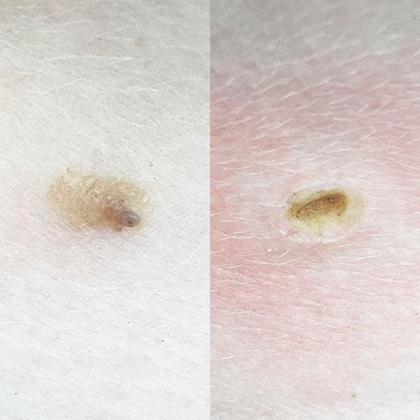 Как удалить папилломы медом?